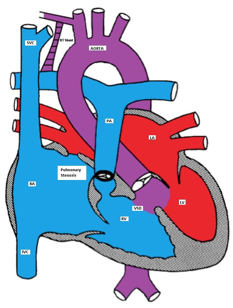 Tetralogy of Fallot with a BT shunt